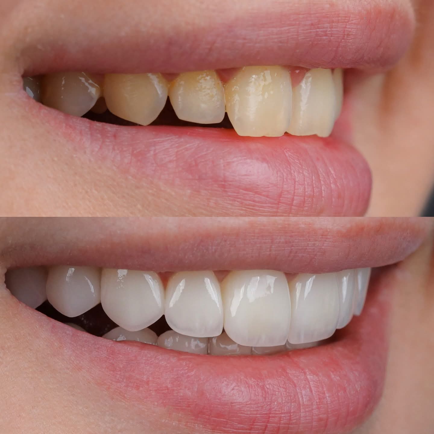 Teeth Whitening