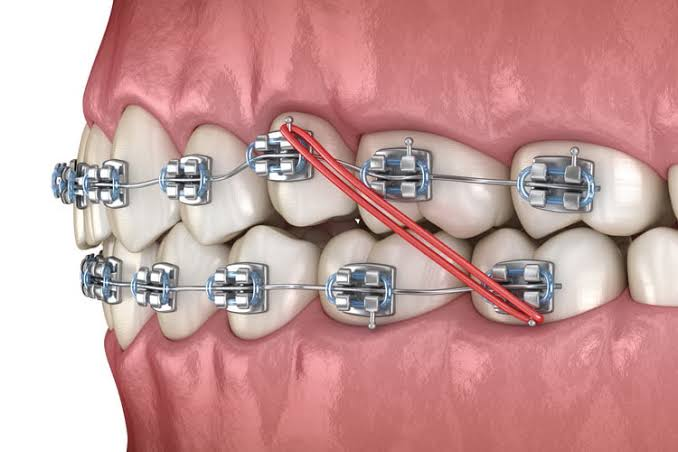Dental Braces