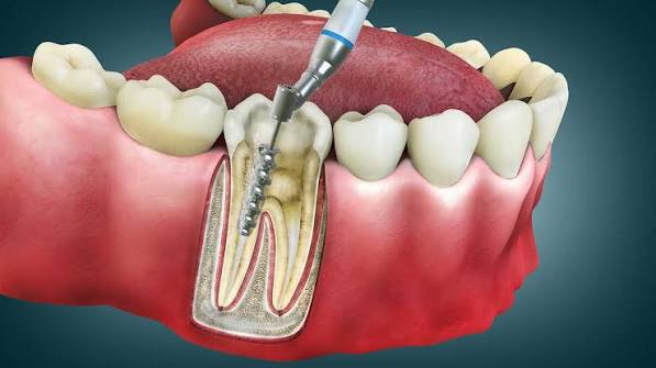 Root Canal Therapy
